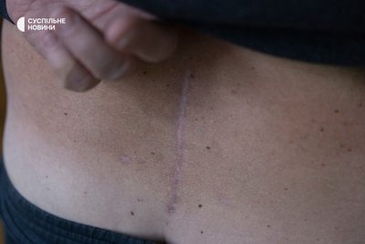 Чоловік показує штам від операції на хребті Чоловік показує штам від операції на хребті