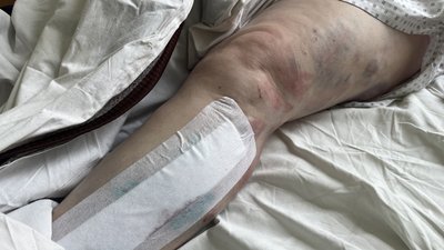 58-річна Марина Голотвіна, в автівку якої поцілив російський безпілотник 8 травня 2025 року у Великих Проходах, зазнала поранення ноги 58-річна Марина Голотвіна, в автівку якої поцілив російський безпілотник 8 травня 2025 року у Великих Проходах, зазнала поранення ноги