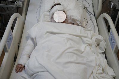 "Мене в обличчя вдарило щось плоске і велике". У реанімації перебуває подружжя, поранене вналідок удару РФ по Дніпру "Мене в обличчя вдарило щось плоске і велике". У реанімації перебуває подружжя, поранене вналідок удару РФ по Дніпру