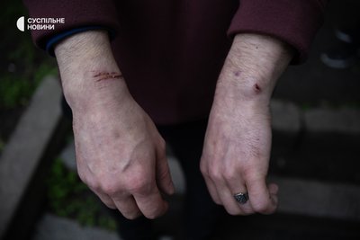 Колишній в'язень, якого 23 травня Росія передала Україні під час обміну полоненими, показує сліди від наручників Колишній в'язень, якого 23 травня Росія передала Україні під час обміну полоненими, показує сліди від наручників