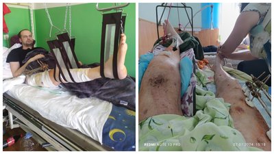 Травмований після обстрілу Супрунівки на Полтавщині заново вчиться ходити Травмований після обстрілу Супрунівки на Полтавщині заново вчиться ходити