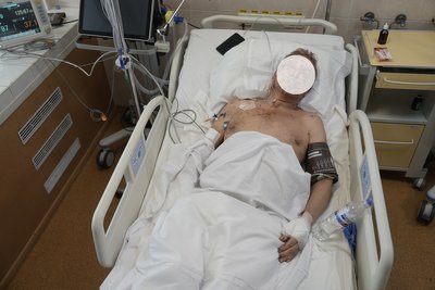 "Мене в обличчя вдарило щось плоске і велике". У реанімації перебуває подружжя, поранене вналідок удару РФ по Дніпру "Мене в обличчя вдарило щось плоске і велике". У реанімації перебуває подружжя, поранене вналідок удару РФ по Дніпру