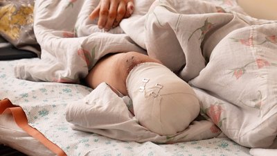 "Пробув на морозі дві доби": в обласній Кропивницького лікують перші випадки обмороження 2026 року "Пробув на морозі дві доби": в обласній Кропивницького лікують перші випадки обмороження 2026 року