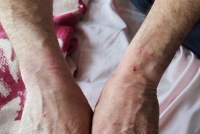 Вадим Рудюк показує руки після побоїв Вадим Рудюк показує руки після побоїв