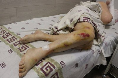 Поранені внаслідок нічної атаки РФ отримали лікування Поранені внаслідок нічної атаки РФ отримали лікування