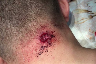 Сергію Стерненку вистрілили у потилицю під час другого нападу Сергію Стерненку вистрілили у потилицю під час другого нападу