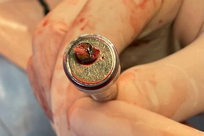Київські кардіохірурги дістали металевий уламок із серця військового Київські кардіохірурги дістали металевий уламок із серця військового