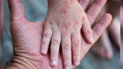 Менінгококова інфекція