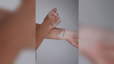Всесвітній день вітиліго: вінничанка розповіла про особливості недуги Всесвітній день вітиліго: вінничанка розповіла про особливості недуги