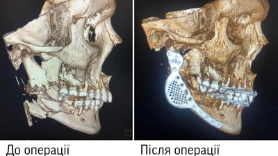 У Вінниці виконали унікальну операцію з відновлення нижньої щелепи із застосуванням 3D-технологій