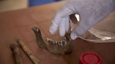 Американські вчені виростили зі свинячого жиру кістку щелепи