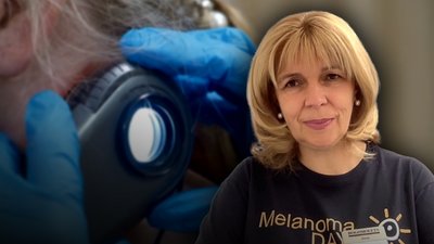 День діагностики меланоми в Україні: як її виявити та хто в групі ризику