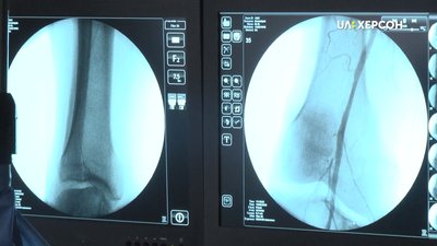 Операція відбувається за допомоги рентгену Операція відбувається за допомоги рентгену