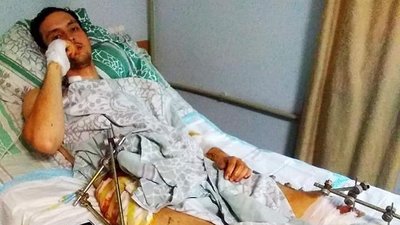 Переніс 12 операцій. Історія одужання воїна з Івано-Франківська Мар'яна Данилюка Переніс 12 операцій. Історія одужання воїна з Івано-Франківська Мар'яна Данилюка