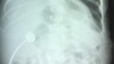 Львівські хірурги прооперували немовля із важкою вадою діафрагми