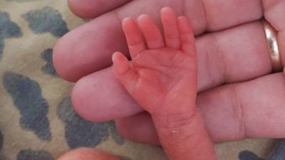 Історія "мізинчика". У Сумах народився хлопчик на 24-му тижні