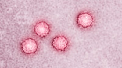 Гепатит А: симптоми, профілактика та чи можна робити щеплення. Пояснює лікарка Гепатит А: симптоми, профілактика та чи можна робити щеплення. Пояснює лікарка