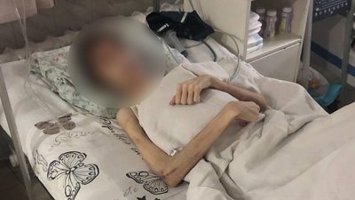 В Одесі планують вилучити з родини підлітка, який потрапив до лікарні з анорексією