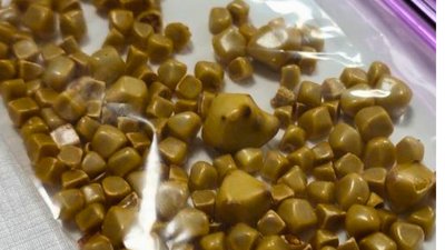 Каміння у жовчному міхурі