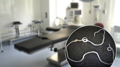 На Рівненщині лікарі видалили пацієнтці з-під шкіри гельмінта завдовжки 9 сантиметрів