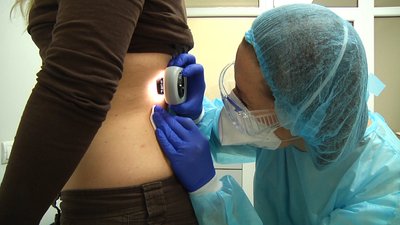 В Житомирській області кількість хворих на меланому щороку зростає на три відсотки