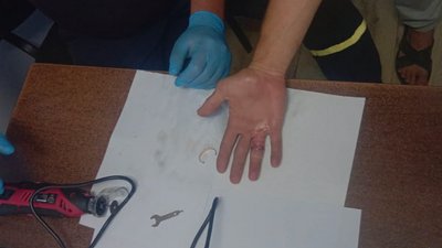 Рятувальники допомогли чоловікові зняти обручку з набряклого пальця у Дубні на Рівненщині