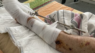 Прошиті кістки та відірвані пальці: як головний енергетик ХТЗ лікується після обстрілу Харкова Прошиті кістки та відірвані пальці: як головний енергетик ХТЗ лікується після обстрілу Харкова