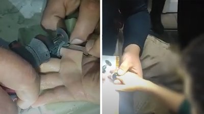 Рятувальники вивільнили палець 7-річної дитини з алюмінієвого кільця