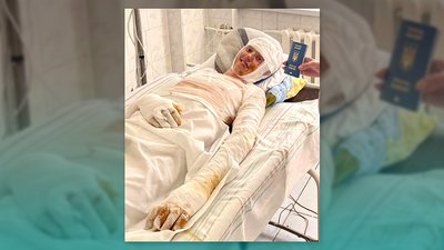 Пасажира автобуса, який обгорів у ДТП на Рівненщині, лікуватимуть в Італії. Що з іншими травмованими