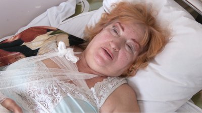 Через ожеледицю побільшало пацієнтів у травматології Черкаської Третьої міської лікарні