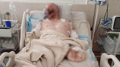 Серце билось дуже тихо: у столиці рятують черкащанина, якому під Бахмутом відірвало дві руки та ногу Серце билось дуже тихо: у столиці рятують черкащанина, якому під Бахмутом відірвало дві руки та ногу