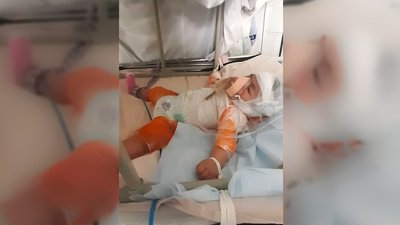 У Кропивницькому 5-місячна дитина перебуває в реанімації з опіками
