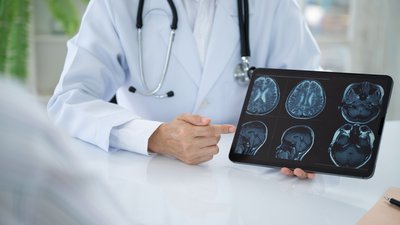 Епілепсія: як розпізнати напад та чи можна вилікувати хворобу