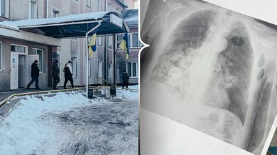 Жителю Дубенщини загрожує ампутація через невчасне звернення до медиків