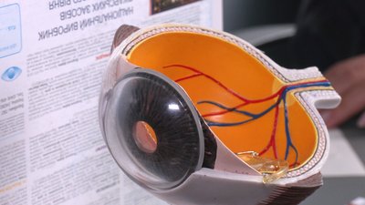 Що відомо про захворювання на глаукому на Івано-Франківщині Що відомо про захворювання на глаукому на Івано-Франківщині