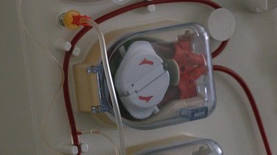 11 років на діалізі або раптовий дзвінок серед ночі. Як на Франківщині проводять трансплантації 11 років на діалізі або раптовий дзвінок серед ночі. Як на Франківщині проводять трансплантації