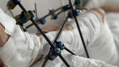 Рану закрили 15-сантиметровим клаптем м'яких тканин Рану закрили 15-сантиметровим клаптем м'яких тканин