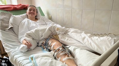 Одна нога коротша за іншу: У Львові лікарі дівчинці в кістку ноги встановили апарат, що буде її розтягувати