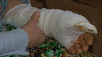 Жінка, якій луцькі медики пришили палець, готується до виписки Жінка, якій луцькі медики пришили палець, готується до виписки