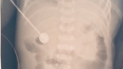 У Львові медики прооперували немовля, яке народилося без половини діафрагми У Львові медики прооперували немовля, яке народилося без половини діафрагми