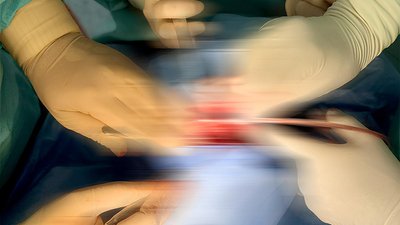 У Києві медики провели операцію з відновлення обличчя військовому