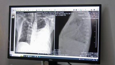 На Волині зросла кількість хворих на туберкульоз дорослих і дітей На Волині зросла кількість хворих на туберкульоз дорослих і дітей