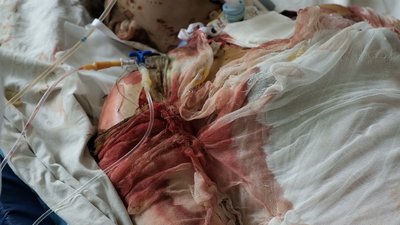 "Три пацієнти померли у реанімації": що відомо про постраждалих внаслідок ракетного обстрілу Вінниці "Три пацієнти померли у реанімації": що відомо про постраждалих внаслідок ракетного обстрілу Вінниці