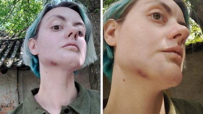 Побиття дружини військовослужбовця працівником центру комплектування в Ужгороді: що відомо про справу