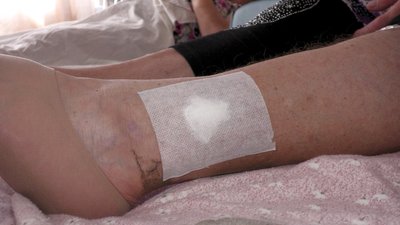 У Харківській області зареєстрували перший за два роки випадок сказу людини: як почувається пацієнтка У Харківській області зареєстрували перший за два роки випадок сказу людини: як почувається пацієнтка