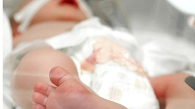 Тенденція до народження недоношених дітей щороку зростає - експерт