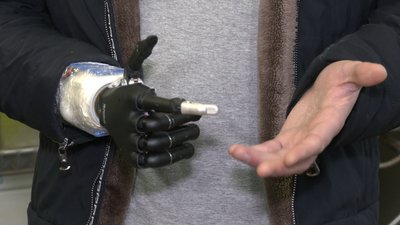 Керується смартфоном: у Харкові показали протез вартістю понад мільйон гривень
