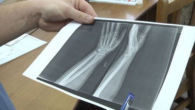 Через ожеледь у луцькому травмпункті зросла кількість звернень