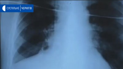 У Чернігові вперше зробили комбіновану операцію на серці й легенях У Чернігові вперше зробили комбіновану операцію на серці й легенях