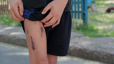 Вижили під час обстрілу касетними снарядами: історії вцілілих чернігівців Вижили під час обстрілу касетними снарядами: історії вцілілих чернігівців